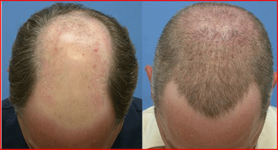 Minoxidil Kullananlar